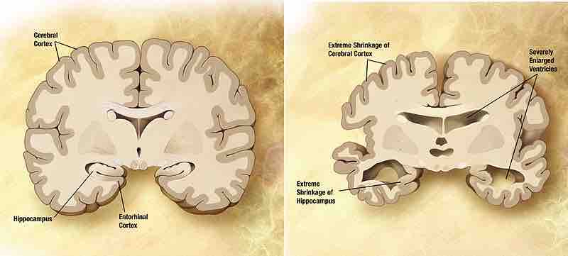 Normal brain vs. brain affected by Alzheimer's disease