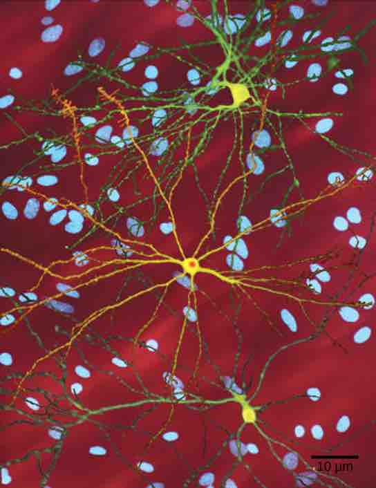 Effects of Huntington's disease on neurons