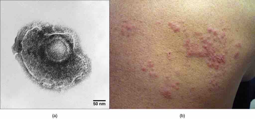 Chicken pox virus