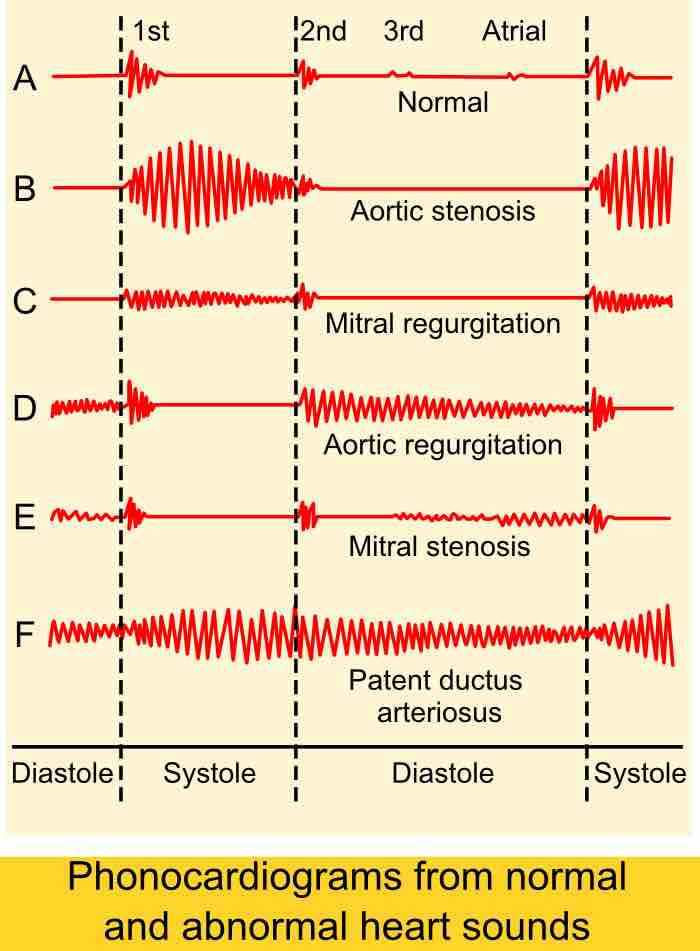 Auscultogram of heart sounds, including murmurs