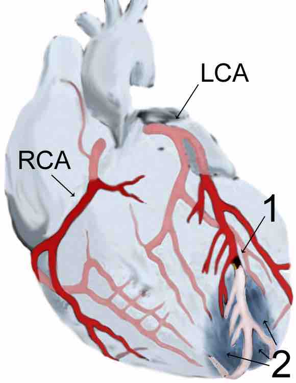 Acute myocardial infarction