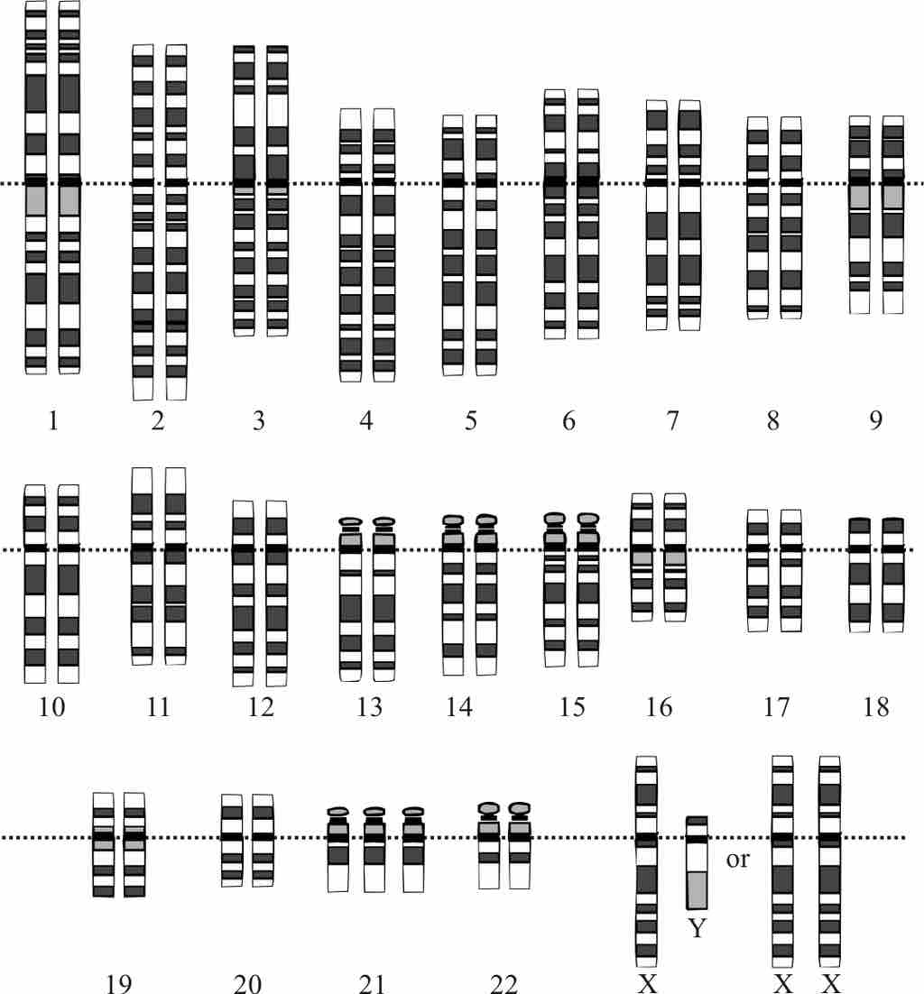 Prenatal diagnosis: Karyotype