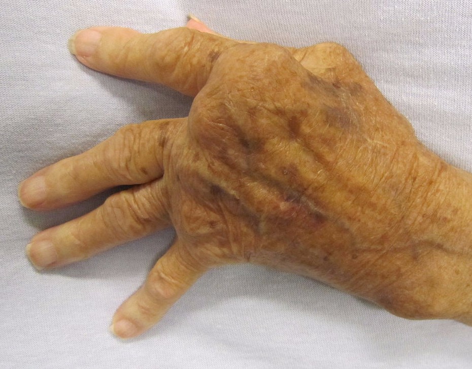 Rheumatoid Arthritis