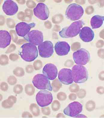 Bone Marrow Aspirate Smear