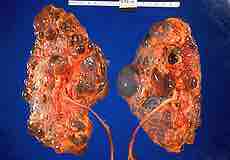 Polycystic Kidney Disease