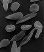 Sickle cell anemia is caused by a change in hemoglobin's primary structure