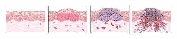 Tumor Angiogenesis