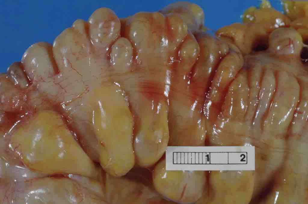 Sigmoid colon