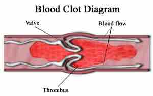 Blood clot diagram.