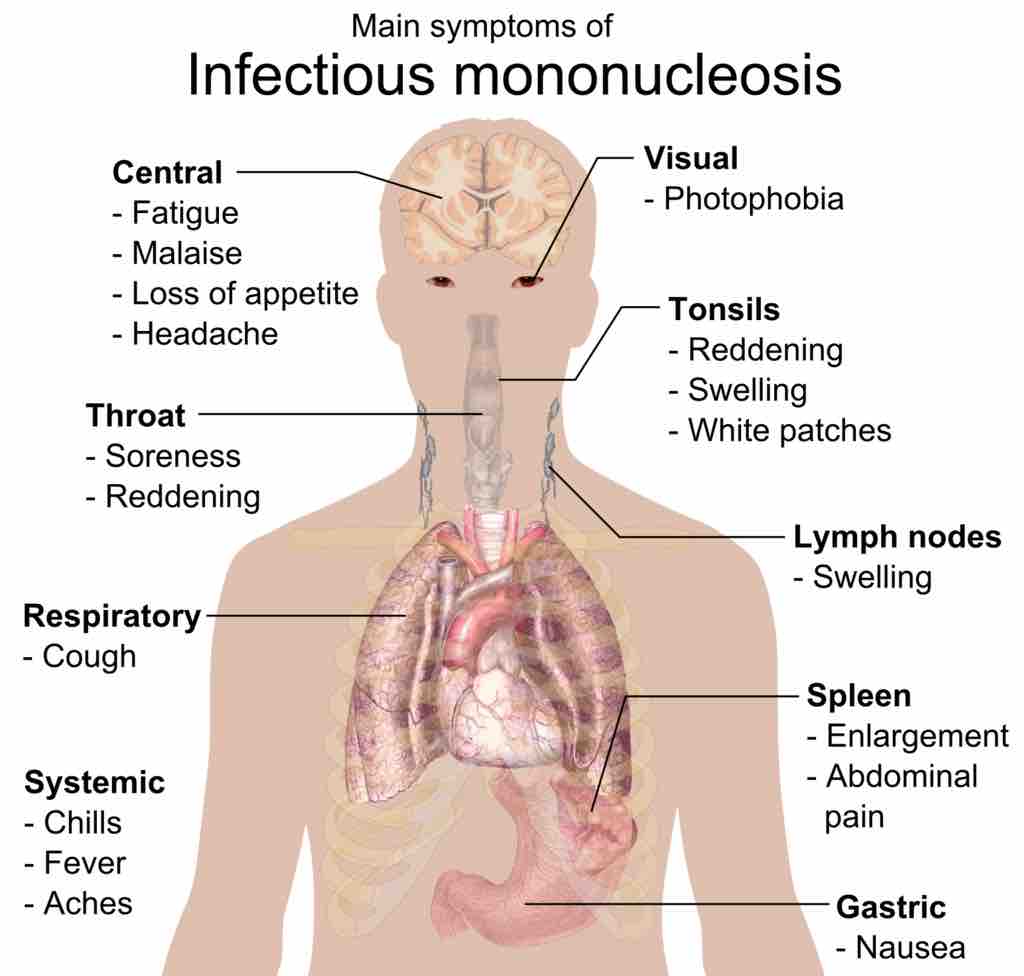 Main Symptoms of Infectious Mononucleosis