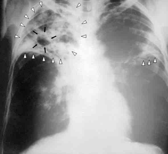 Chest x-ray of a patient with tuberculosis.