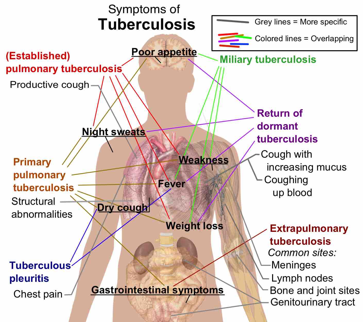 Tuberculosis Symptoms.