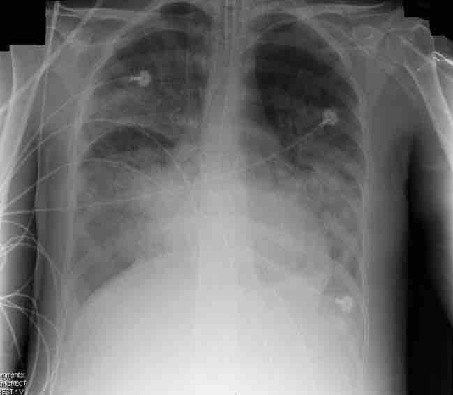 X-ray of patient with ARDS.