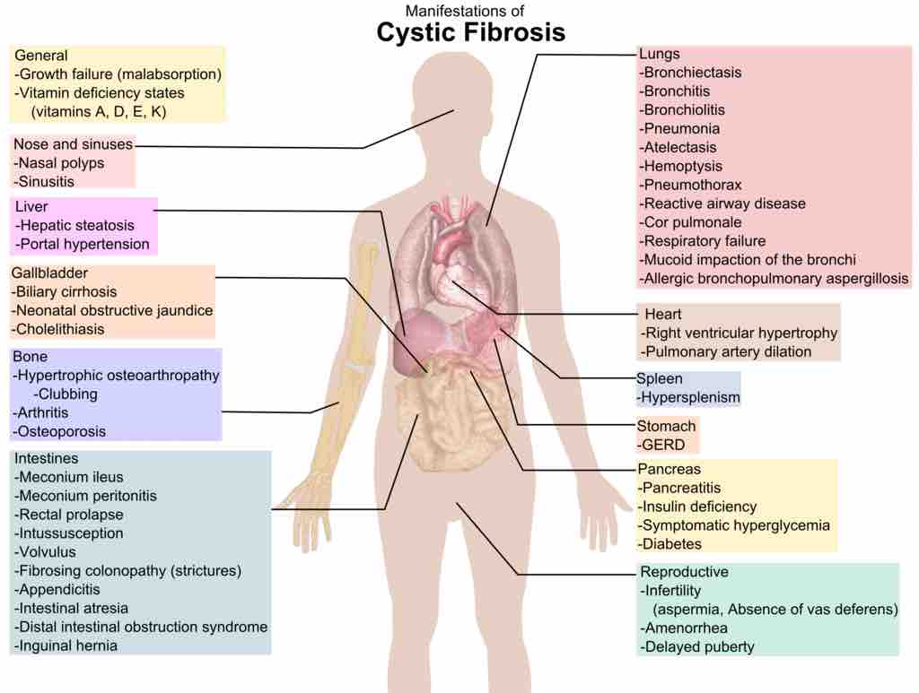 Clinical Manifestations of Cystic Fibrosis