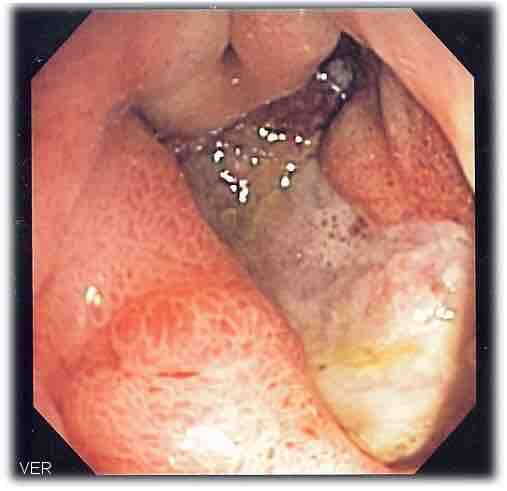 Deep gastric ulcer