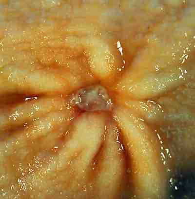 Benign gastric ulcer