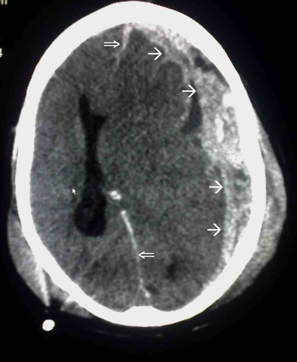 Subdural hematoma is a possible result of traumatic head injury