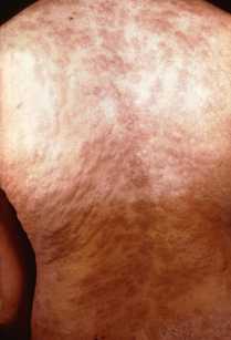 Secondary syphilis rash on the back. 