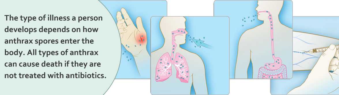 Slideshow image 1: The type of illness a person develops depends on how anthrax spores enter the body. All types of anthrax can cause death if they are not treated with antibiotics. 