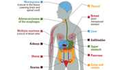 Overweight and Obesity are Associated with Cancer