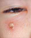 This is an image of a girl with a secondary skin infection on her face due to chickenpox.