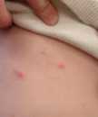 Breakthrough varicella on the abdomen of a vaccinated child.