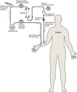 Hemodialysis Illustration