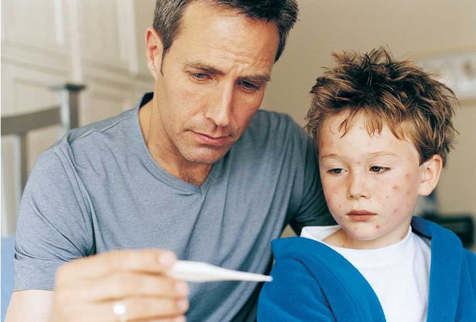 Boy with chickenpox and fever