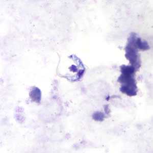 	Trypanosomiasis, African