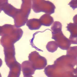 	Trypanosomiasis, African