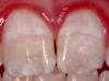 Image of moderate fluorosis. All surfaces of teeth affected with opaque areas and teeth show marked wear and brown staining. 