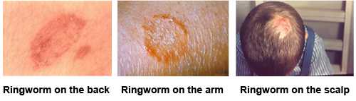 Composite image. First image has ringworm on the back.  Second image has ringworm on the arm.  Third image has ringworm on the scalp