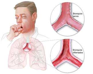 Diagrama de los pulmones que muestra un bronquio sano y uno inflamado.