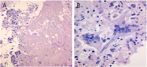 A collage of microscopic views of tissues showing necrosis and giant cell arteritis.