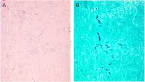 Microscopic views of tissues surrounding the spinal cord comparing the visibility of Arachnoiditis.