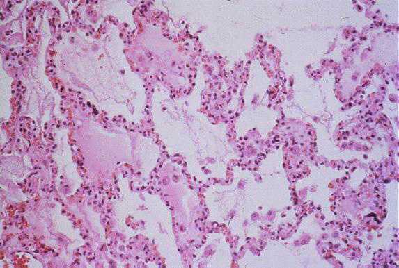 low-power photomicrograph of interstitial pneumonitis and intraalveolar edema