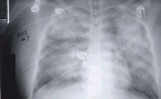 x-ray view of lungs of a patient with severe HPS