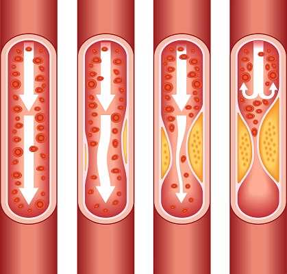 As plaque builds up in the arteries of a person with heart disease, the inside of the arteries begins to narrow, which lessens or blocks the flow of blood.