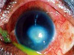 This patient had a corneal ulcer resulting from loss of sensation of the cornea (surface) of the eye and subsequent injury from dust or other particle scratching the surface of the eye without the patient feeling it. Untreated corneal ulcer may result in blindness.