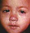 Child with measles