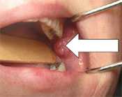 Buccal cavity