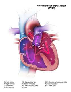 Atrioventricular Septal Defect (AVSD)