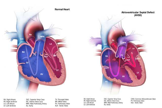 Atrioventricular Septal Defect (AVSD)