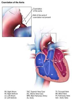 Coarctation of Aorta