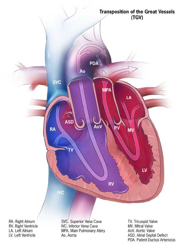 dextro-Transposition of the Great Arteries (d-TGA)