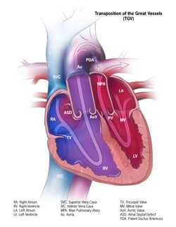 Transposition of the Great Arteries