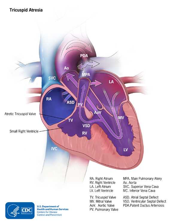 Tricuspid Atreasia