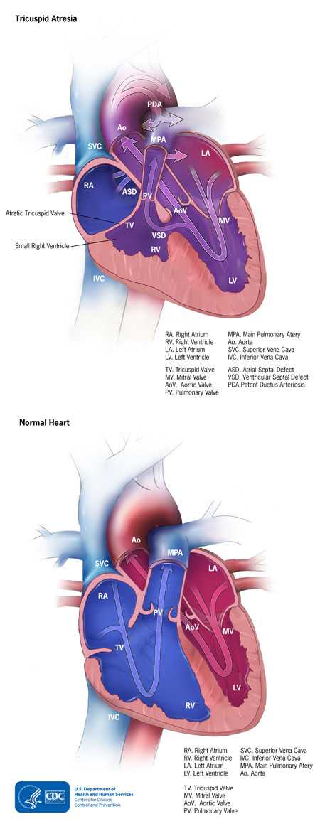 Tricuspid Atresia Comparison