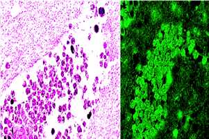 	Photo: Naegleria fowleri in a brain section