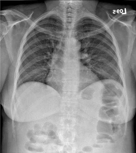 Figure 4c. The chest image in figure 4a is illustrated with contrast enhancement based on the unsharp mask of figure 4b. The unsharp mask values are used to adjust the raw image values so that the image may be displayed with a narrow latitude grayscale rendition resulting in improved tissue contrast. An equivalent photographic process would use the unsharp mask as illustrated to illuminate the orginal radiograph and make a high contrast copy.